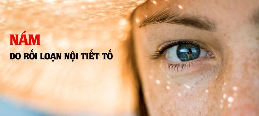 Hiểu Về Nám Nội Tiết: Nguyên Nhân, Triệu Chứng và Cách Điều Trị