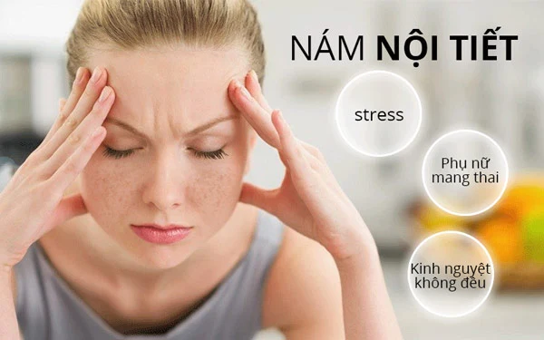 Hiểu Về Nám Nội Tiết: Nguyên Nhân, Triệu Chứng và Cách Điều Trị