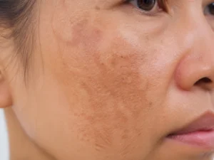 Cận cảnh vùng da mặt có các mảng nám và đốm tàn nhang tự nhiên
