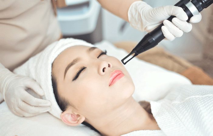 Trị Nám Bằng Laser