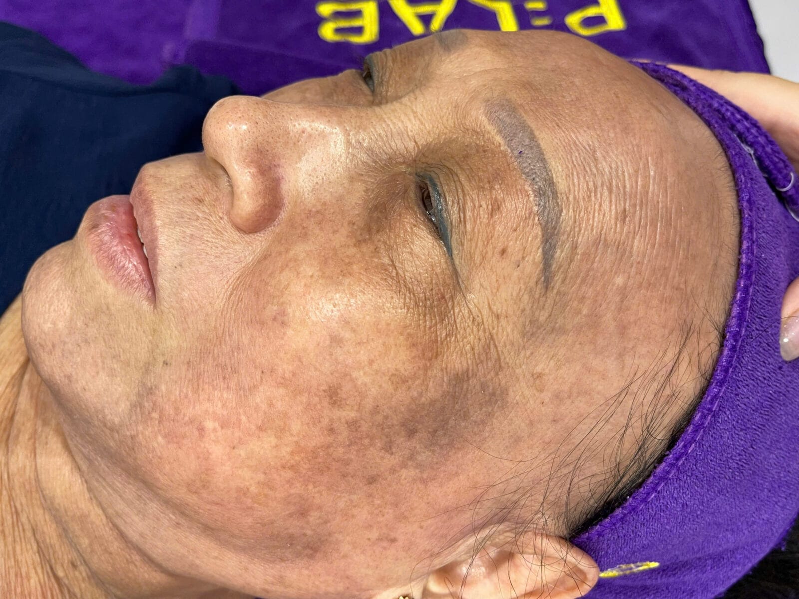 Thảm hoạ nám – da tổn thương sau nhiều lần điều trị nám sai cách